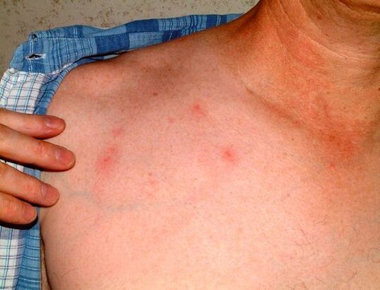 Symptome von Parasiten unter der Haut