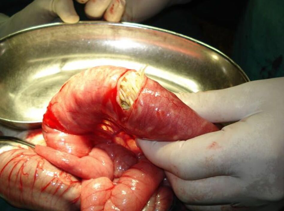 Madenwürmer im menschlichen Darm